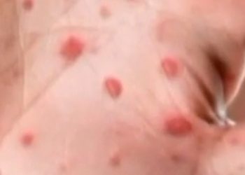 Hundreds of students quarantine amid measles outbreaks