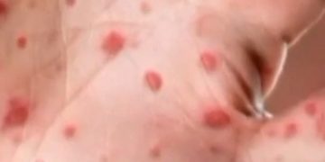 Hundreds of students quarantine amid measles outbreaks