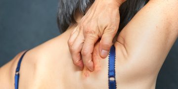 Shingles is linked to inflammation in the brain. Research shows how to cut dementia risk.