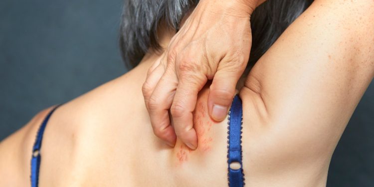 Shingles is linked to inflammation in the brain. Research shows how to cut dementia risk.